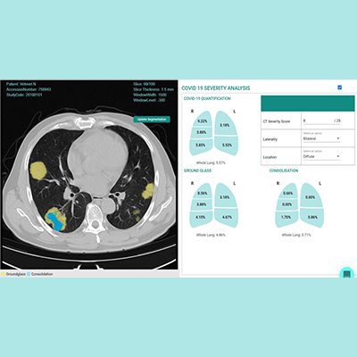 LungIQ – AI based solution for chest CT severity scoring